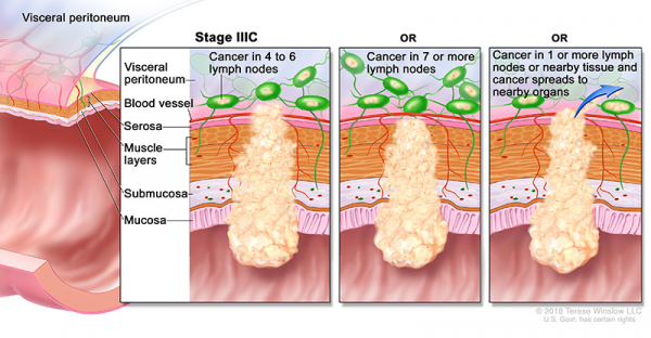 colorectal-ca-stage-3C_600_312.jpeg
