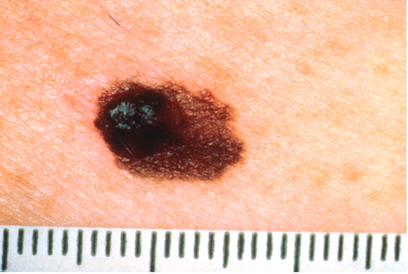SKinCancerPicture1.jpg