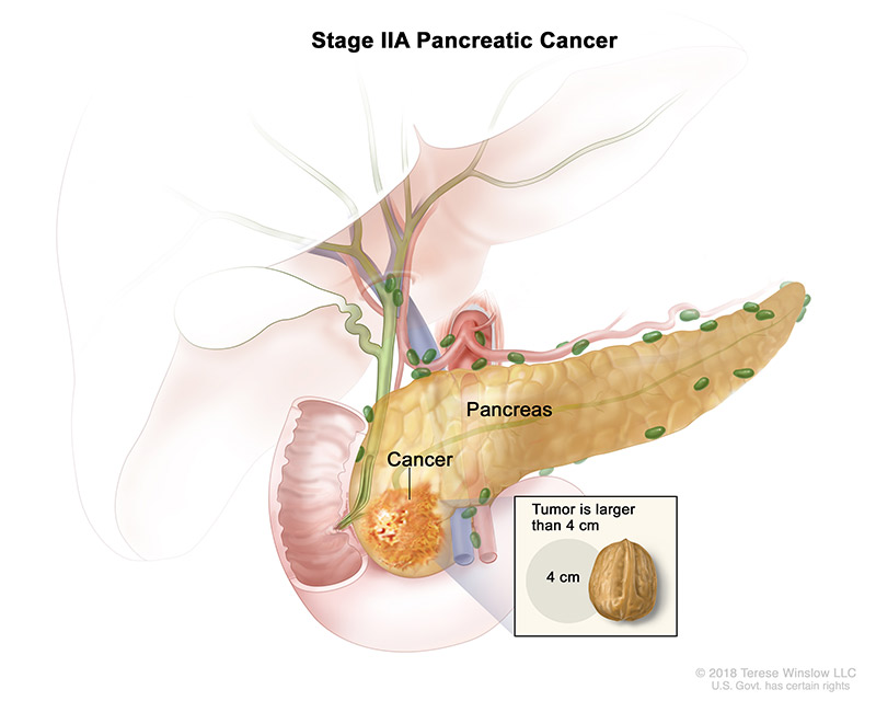 pancreatic-ca-stage-2A.jpeg