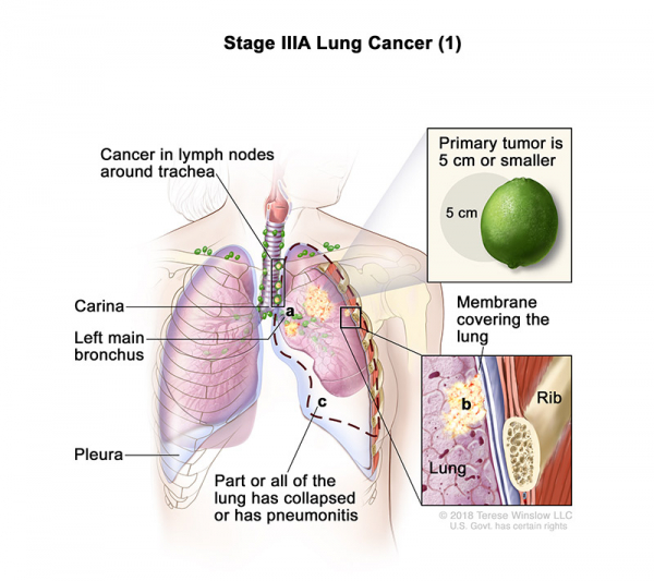 lung-carcinoma-stage3APart1_600_533.jpeg