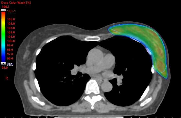 Whole Breast Radiation.png