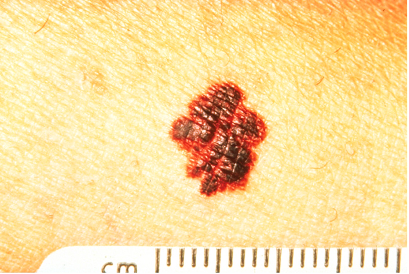 SkinCancerPicture2.jpg