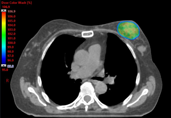 Partial Breast Radiation.png