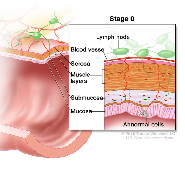 colorectal-ca-stage-0_600_557.jpeg