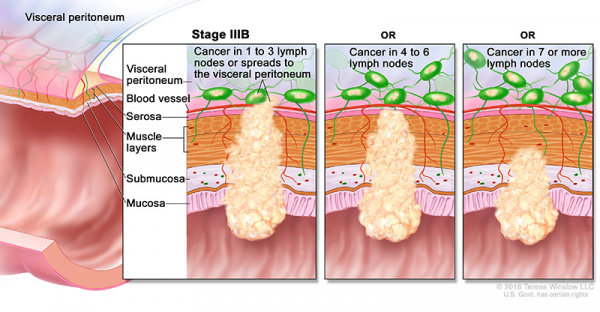 colorectal-ca-stage-3B_600_312.jpeg