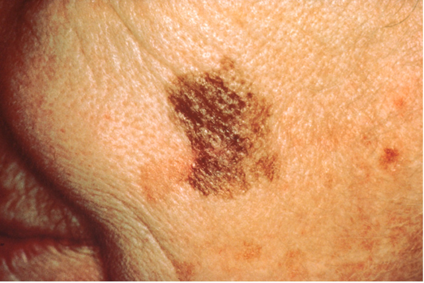 SkinCancerPicture4.jpg