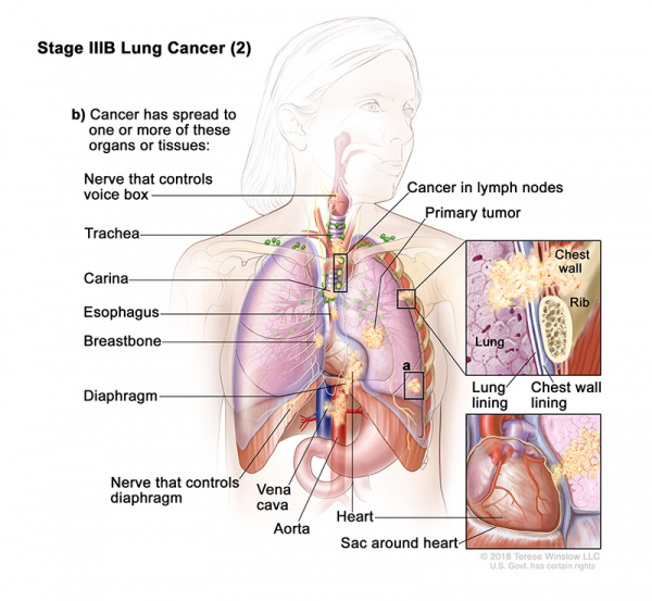 lung-carcinoma-stage3BPart2_600_553.jpeg