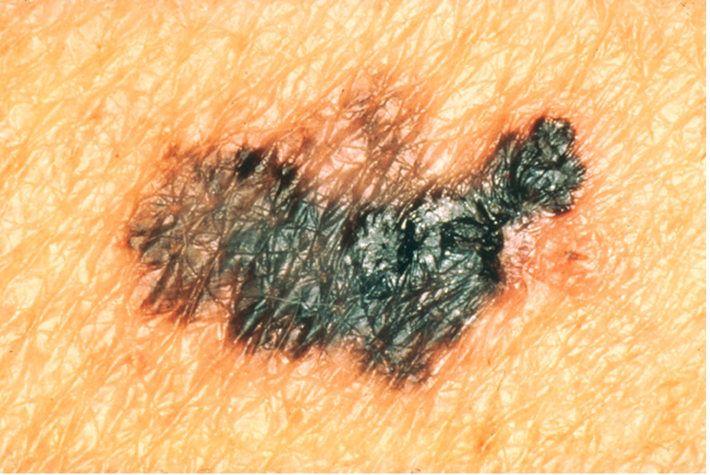 SkinCancerPicture3.jpg