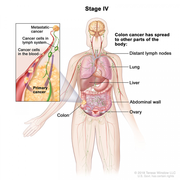 colorectal-ca-stage-4_600_600.jpeg