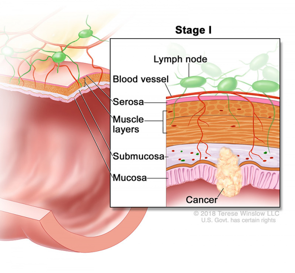 colorectal-ca-stage-1_600_557.jpeg