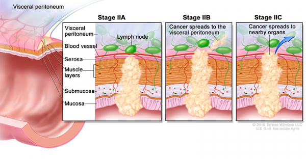 colorectal-ca-stage-2_600_312.jpeg